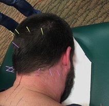 Dry needling on mans head