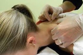 Dry needling treatment on woman's neck.