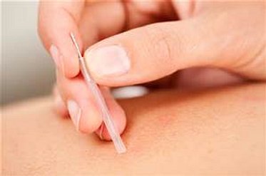 Dry Needling inserted into skin