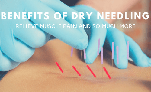 Dry Needling inserted into skin