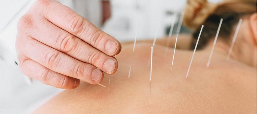 Dry-Needling-1024x722-1